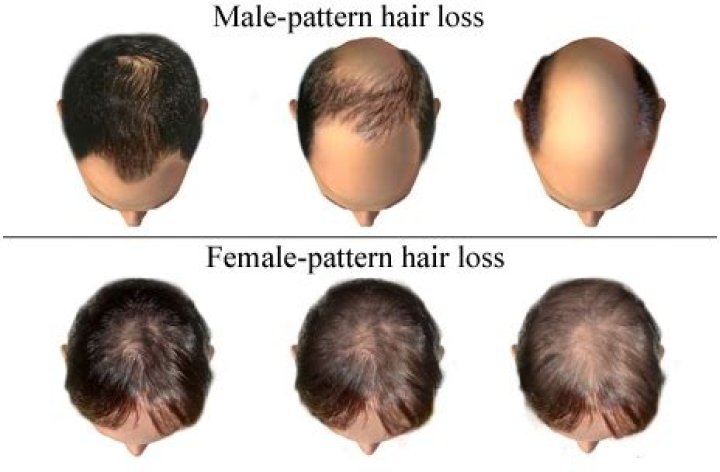 Why do men lose head hair but not body hair?